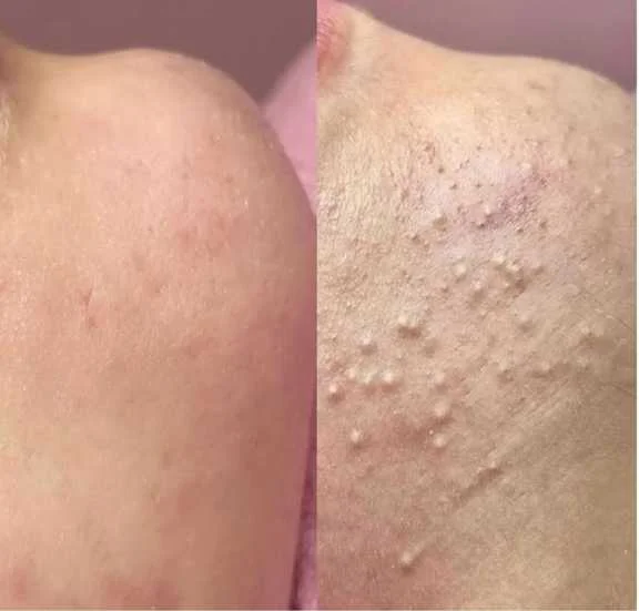 فیشیال تخصصی پوست در سالن مینا میرزایی در کرج
